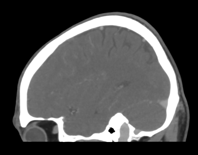 Cerebral venous thrombosis (Radiopaedia 38392-40467 D 15).png