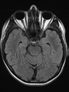 File:Cerebral venous thrombosis (Radiopaedia 38392-40469 Axial FLAIR 9).png