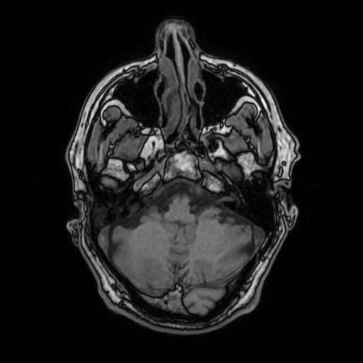 File:Cerebral venous thrombosis with secondary intracranial hypertension (Radiopaedia 89842-106957 Axial T1 52).jpg