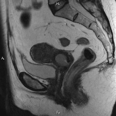 File:Cervical adenocarcinoma (Radiopaedia 65011-73985 Sagittal T2 16).jpg