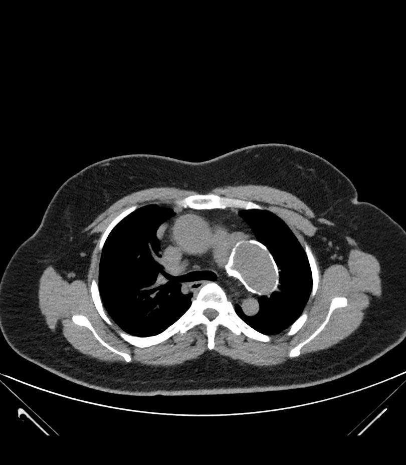 Cervical aortic arch with coarctation and aneurysms (Radiopaedia 44035-47552 Axial non-contrast 19).jpg