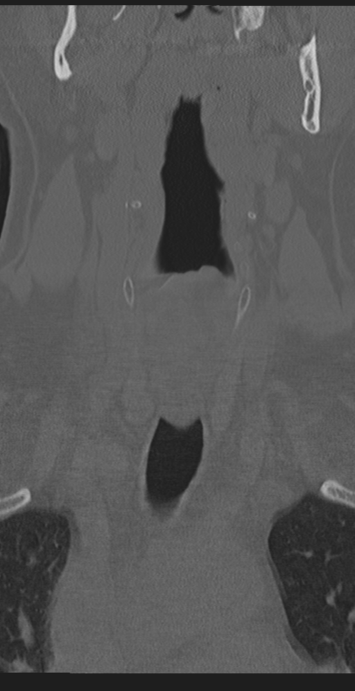Cervical canal stenosis due to ossification of the posterior longitudinal ligament (Radiopaedia 47260-51823 Coronal bone window 5).png