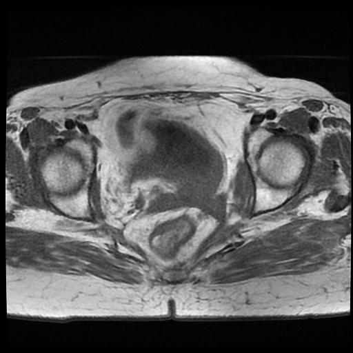 File:Cervical carcinoma (Radiopaedia 70924-81132 Axial T1 10).jpg