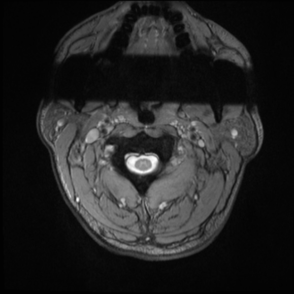 File:Cervical disc extrusion (Radiopaedia 53950-60077 Axial T2 2).jpg