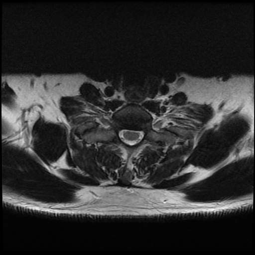 File:Cervical disc extrusion (Radiopaedia 59074-66364 Axial T2 16).jpg