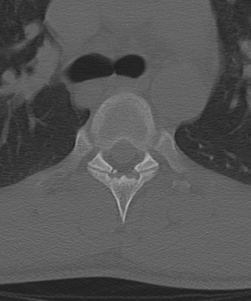 Cervical intercalary bone (Radiopaedia 35211-36748 Axial bone window 85).png