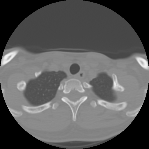 Cervical rib (Radiopaedia 71110-81363 Axial non-contrast 50).jpg