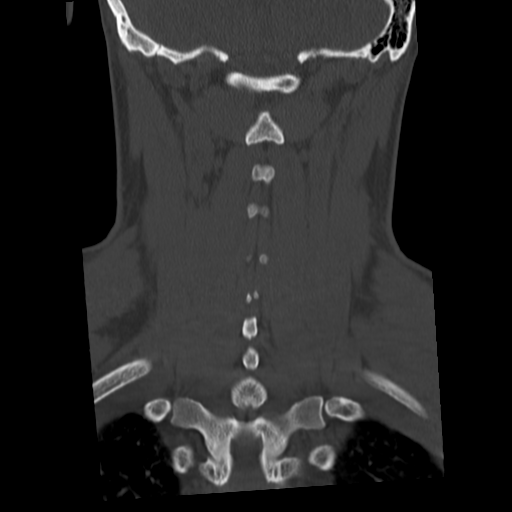 Cervical schwannoma (Radiopaedia 57979-64974 Coronal bone window 42).png