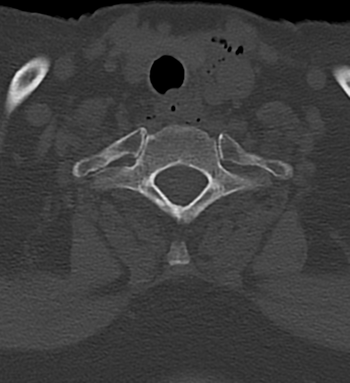 Cervical spine ACDF loosening (Radiopaedia 48998-54070 Axial bone window 49).png