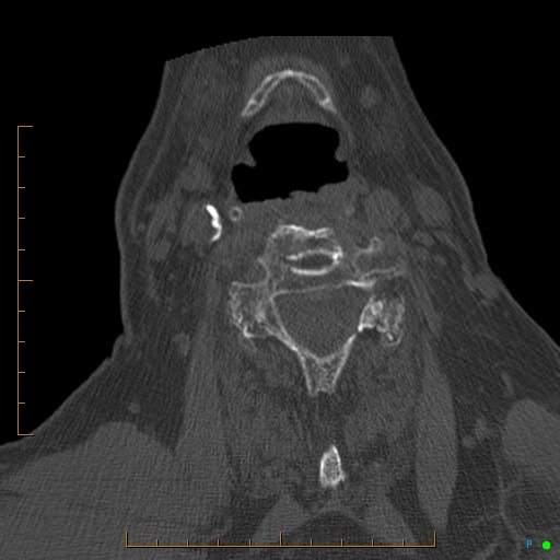 File:Cervical spine fracture - ankylosing spondylitis (Radiopaedia 76835-88706 Axial bone window 128).jpg