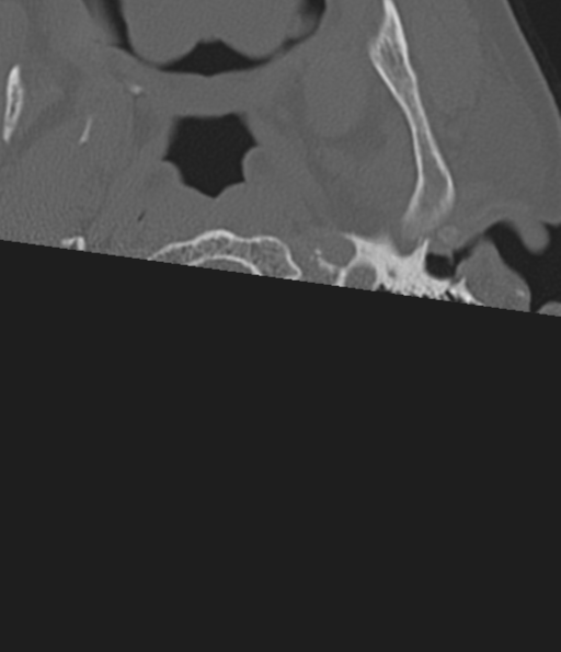 Cervical spine fracture in the setting of ankylosis (Radiopaedia 37038-38715 Axial bone window 3).png