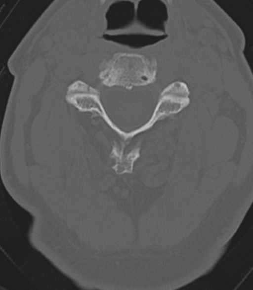 File:Cervical spine fractures with vertebral artery dissection (Radiopaedia 53296-59268 Axial bone window 24).png