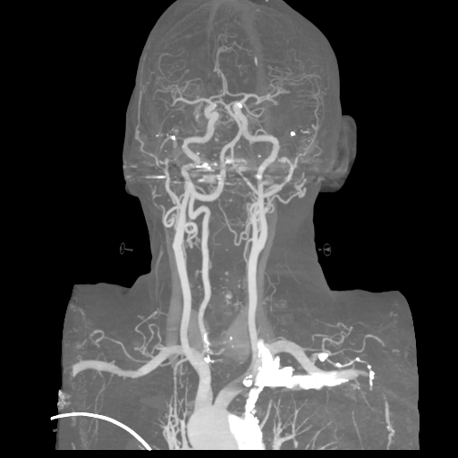 File:Cervical spine fractures with vertebral artery dissection (Radiopaedia 53296-59269 3D MIP 11).png