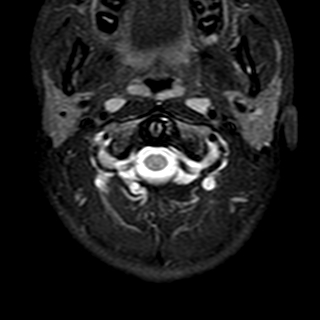 File:Cervical spine posterior ligamentous complex rupture (Radiopaedia 63486-72103 Axial T2 23).jpg