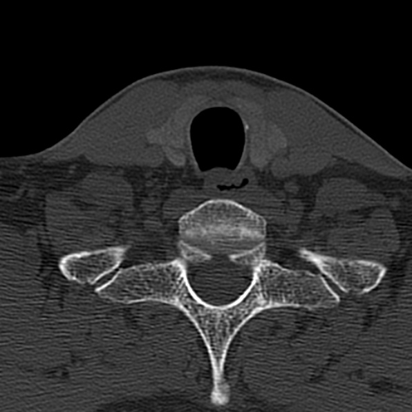 Cervical spondylodiscitis (Radiopaedia 28057-29489 Axial bone window 66).jpg