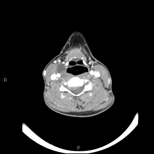 Cervical thymic cyst (Radiopaedia 88632-105335 B 58).jpg