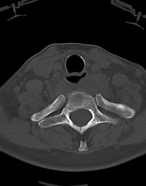 Cervical tuberculous spondylitis (Radiopaedia 39149-41365 Axial bone window 44).png