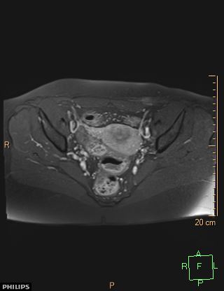 File:Cesarian scar endometriosis (Radiopaedia 68495-78066 Axial T1 C+ fat sat 12).jpg