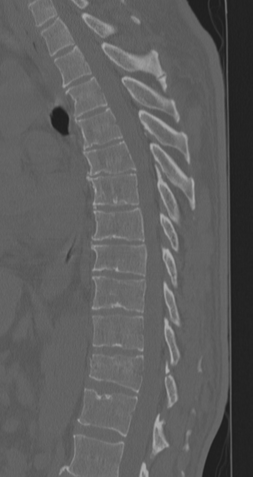 Chance fracture (Radiopaedia 33854-35020 Sagittal bone window 45).png