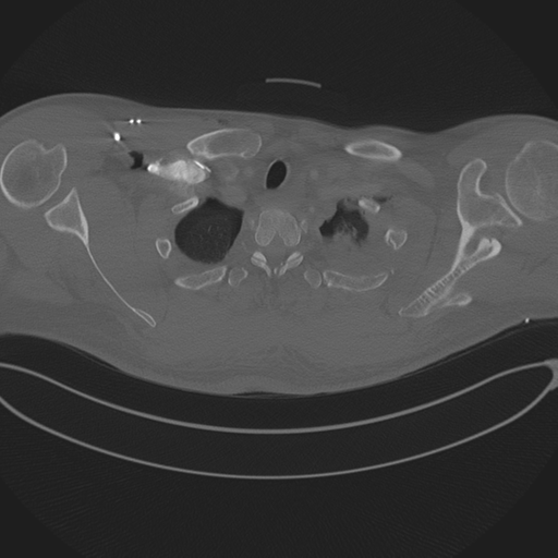 Chest multitrauma - aortic injury (Radiopaedia 34708-36147 Axial bone window 33).png