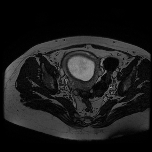 Chiari II malformation - fetal MRI (Radiopaedia 68099-77581 Axial Fiesta 52).jpg