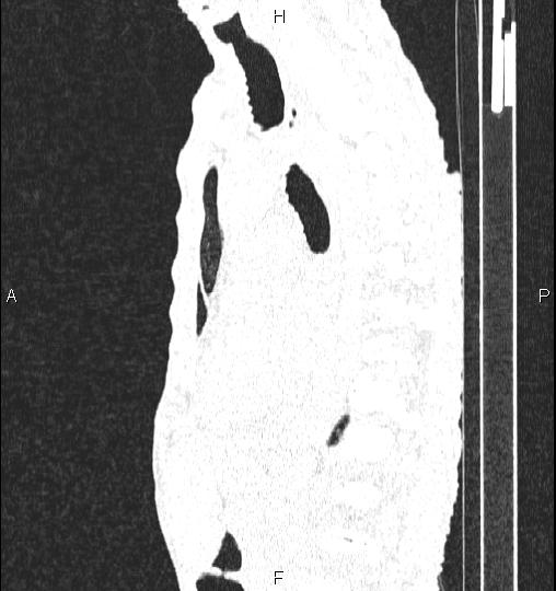 Chilaiditi sign (Radiopaedia 88839-105611 Sagittal lung window 55).jpg