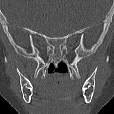 Choanal atresia (Radiopaedia 88525-105975 Coronal bone window 76).jpg
