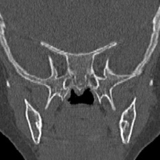 Choanal atresia (Radiopaedia 88525-105975 Coronal bone window 83).jpg