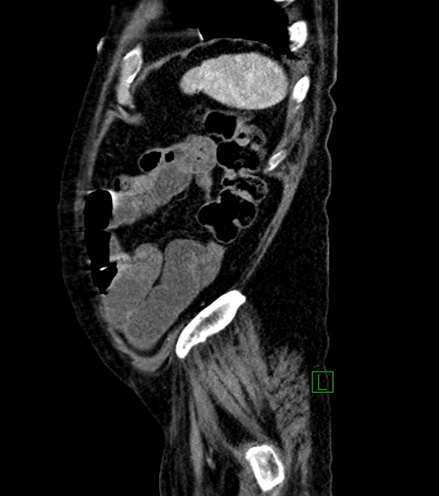 Cholangiocarcinoma with cerebral metastases (Radiopaedia 83519-98629 F 21).jpg