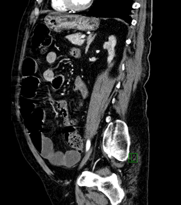 Cholangiocarcinoma with cerebral metastases (Radiopaedia 83519-98629 F 47).jpg