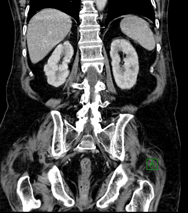 Cholangiocarcinoma with cerebral metastases (Radiopaedia 83519-98629 G 59).jpg