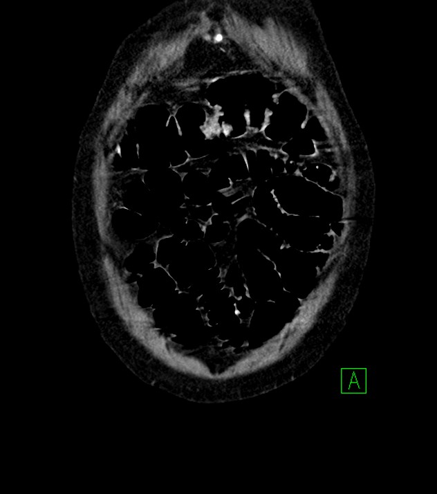 Cholangiocarcinoma with cerebral metastases (Radiopaedia 83519-98629 G 7).jpg