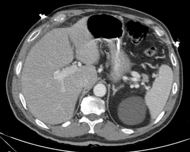 Cholecystitis - perforated gallbladder (Radiopaedia 57038-63916 A 21).jpg