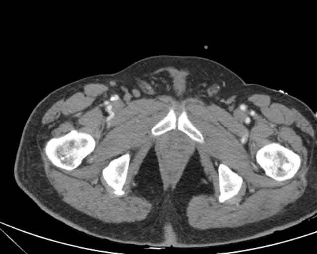 Cholecystitis - perforated gallbladder (Radiopaedia 57038-63916 A 84).jpg