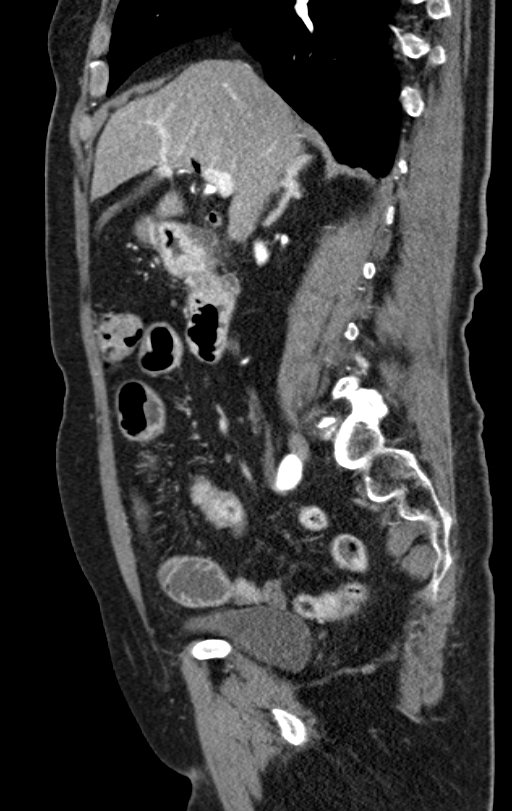 Cholecystoduodenal fistula due to calculous cholecystitis with gallstone migration (Radiopaedia 86875-103077 C 38).jpg