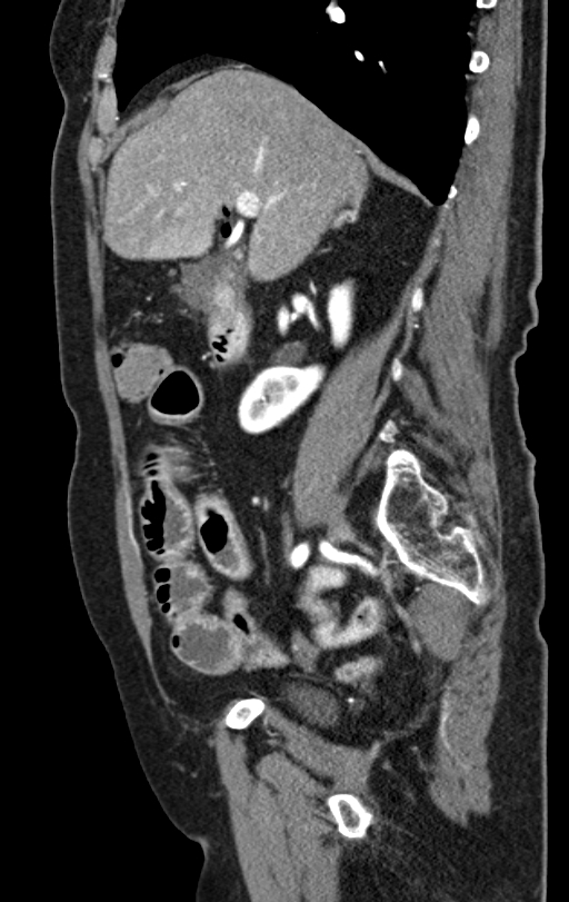 Cholecystoduodenal fistula due to calculous cholecystitis with gallstone migration (Radiopaedia 86875-103077 C 40).jpg