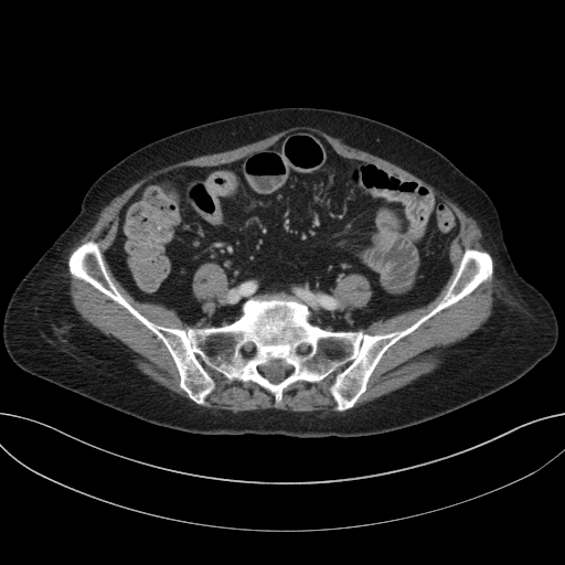 Cholecystoduodenal fistula due to calculous cholecystitis with gallstone migration (Radiopaedia 86875-103077 D 56).jpg