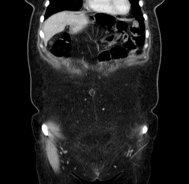 Choledocholithiasis on CT and MRI (Radiopaedia 24825-25087 C 11).jpg