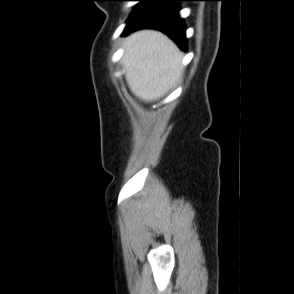 Choledocholithiasis on CT and MRI (Radiopaedia 24825-25087 D 8).jpg