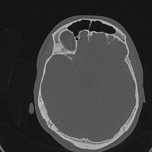 Cholesteatoma (Radiopaedia 70429-80529 Axial bone window 129).jpg