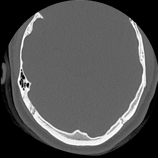 Cholesteatoma (Radiopaedia 84960-100474 Axial bone window 18).jpg