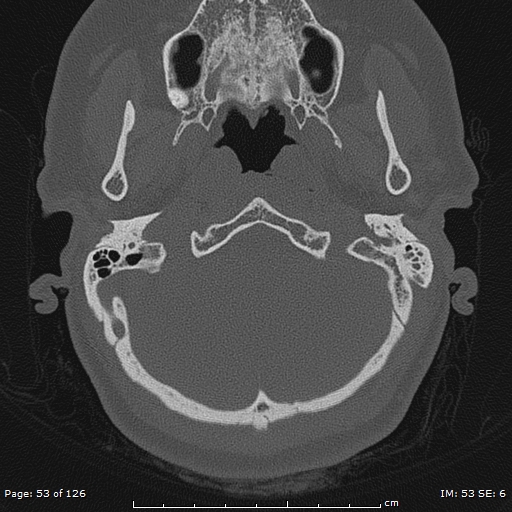 Cholesteatoma - external auditory canal (Radiopaedia 88452-105096 Axial bone window 16).jpg
