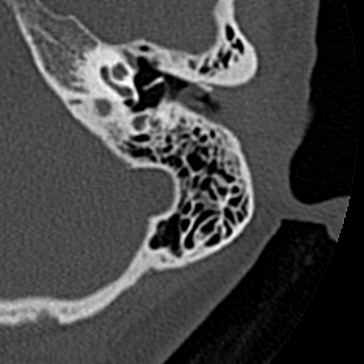 File:Cholesteatoma of the external ear (Radiopaedia 16540-16225 Axial bone window 22).jpg
