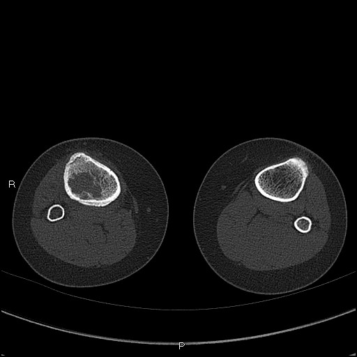 Chondroblastoma (Radiopaedia 62721-71030 Axial bone window 92).jpg