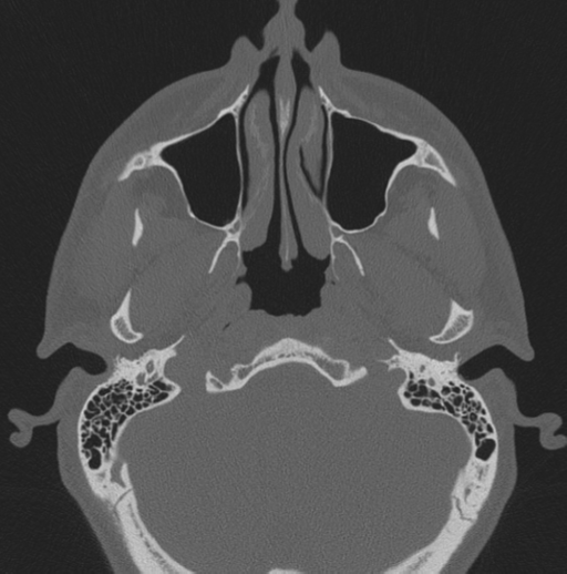 Chondrosarcoma (clivus) (Radiopaedia 46895-51425 Axial bone window 63).png