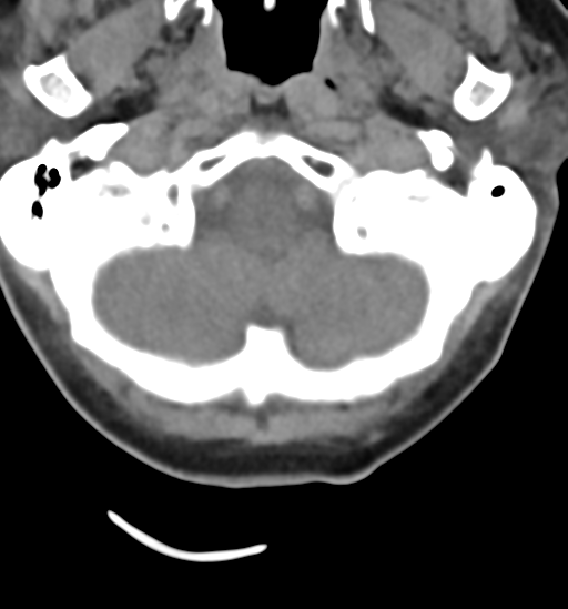 File:Chordoma (C4 vertebra) (Radiopaedia 47561-52188 Axial non-contrast 3).png