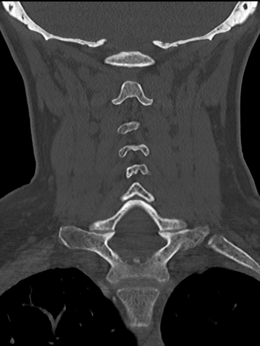 Chordoma (C4 vertebra) (Radiopaedia 47561-52188 Coronal bone window 36).png