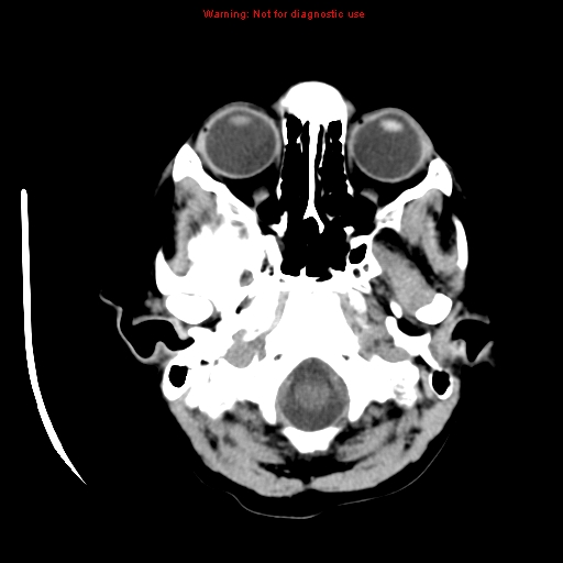 File:Choroid plexus carcinoma - recurrent (Radiopaedia 8330-9168 Axial non-contrast 2).jpg