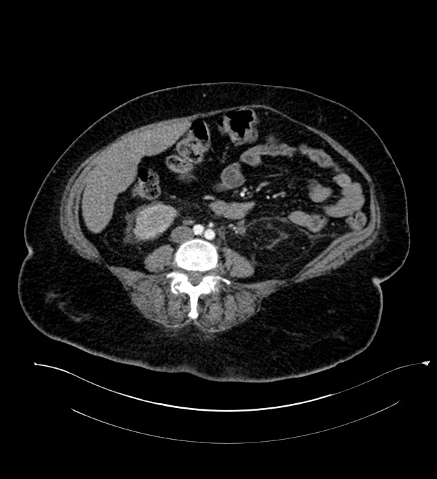 Chromophobe renal cell carcinoma (Radiopaedia 84239-99519 B 72).jpg