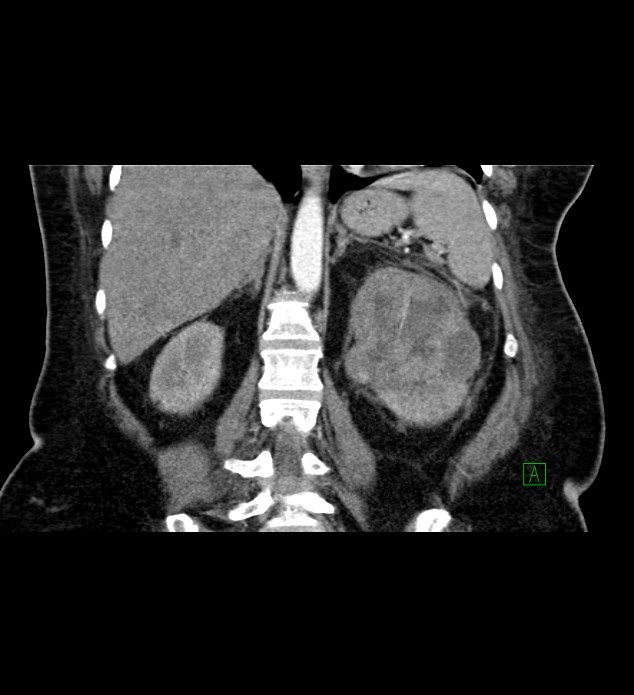 Chromophobe renal cell carcinoma (Radiopaedia 84239-99519 C 60).jpg